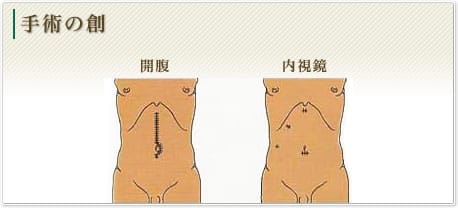 腹筋 開腹 手術 【健康ブログ】私の体験談、手術後の回復には筋トレ！！